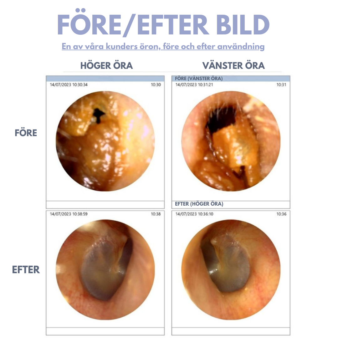 Smart medical cutting-edge technology - visual ear canal cleaning