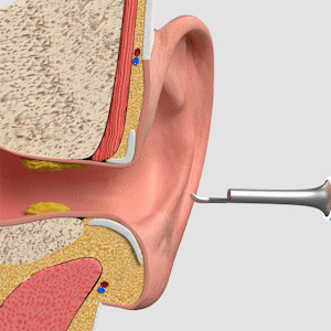 Smart medical cutting-edge technology - visual ear canal cleaning